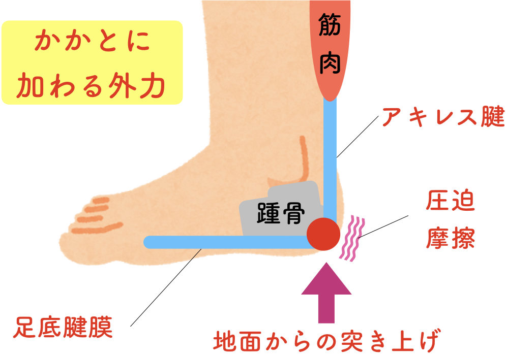 スポーツをしている子供のかかとの痛み（踵骨骨端炎･セーバー病）